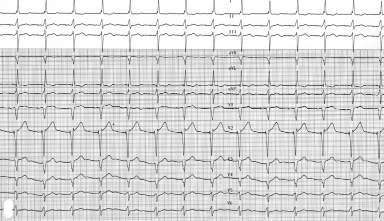trace-4-6-ecg