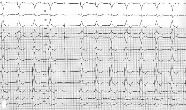 trace-4-7-ecg