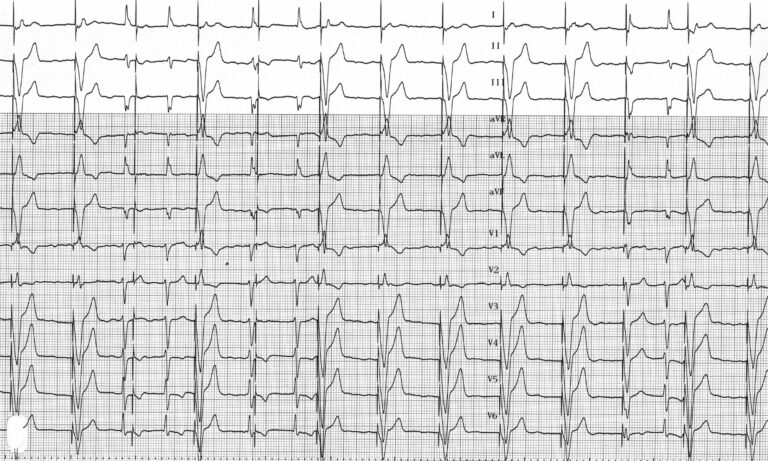 trace-4-8-ecg