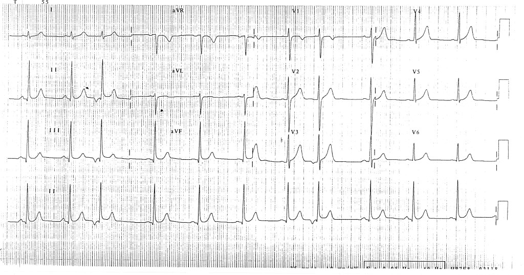trace-5-1-ecg