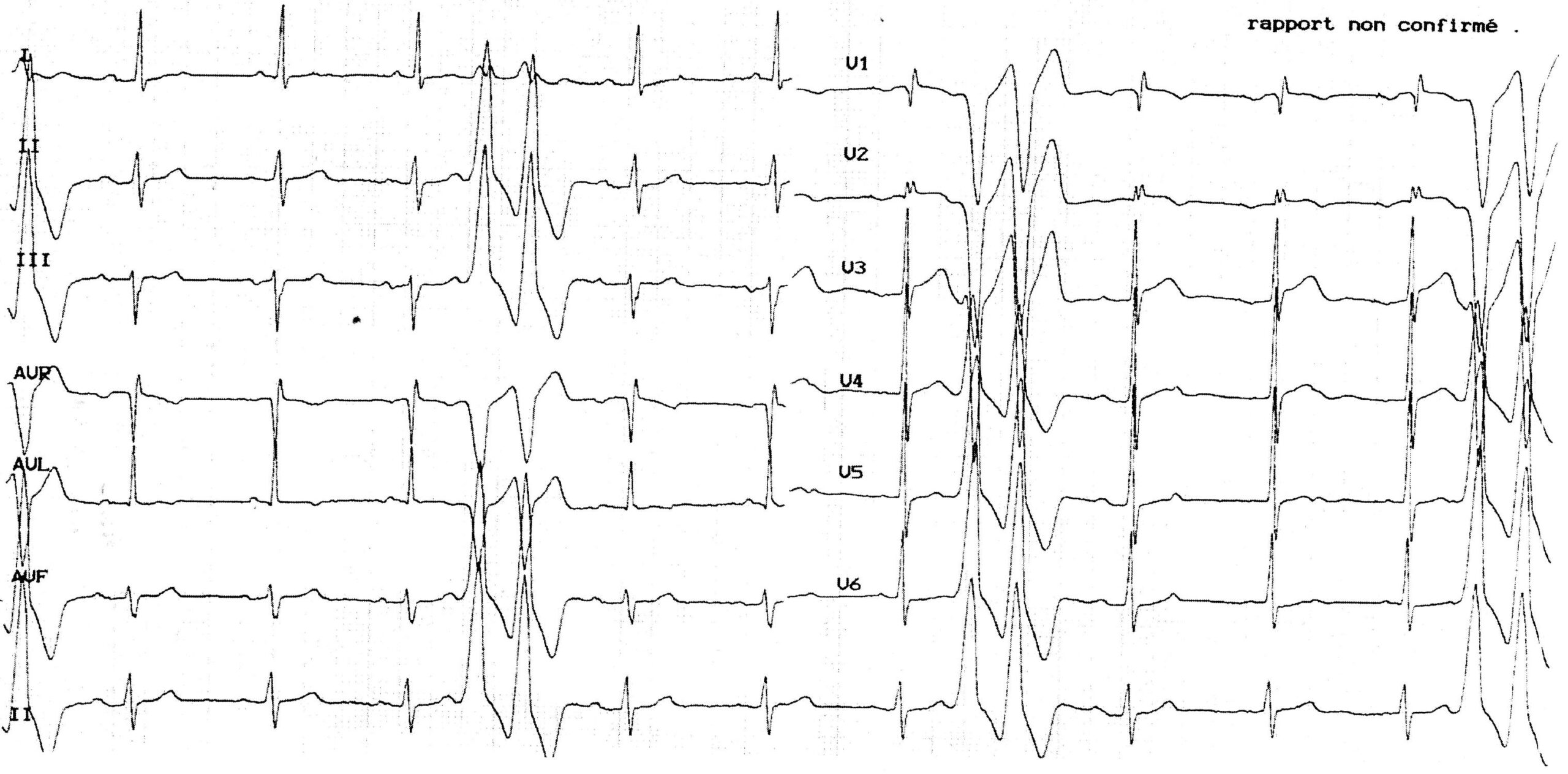 trace-5-10-ecg