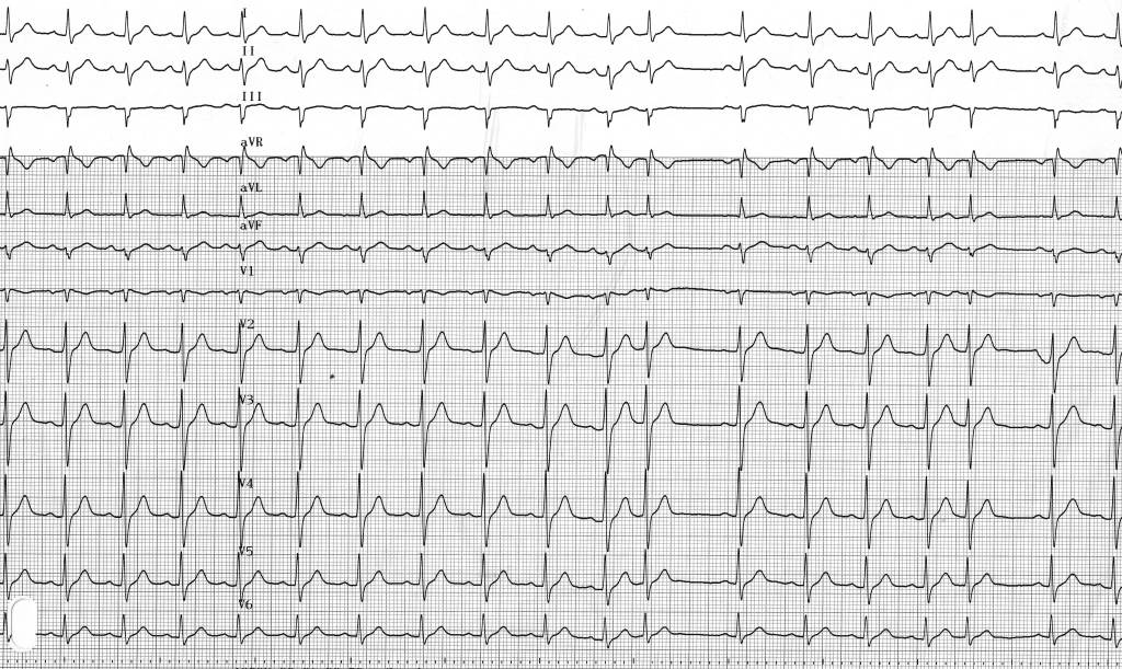 trace-5-2-ecg