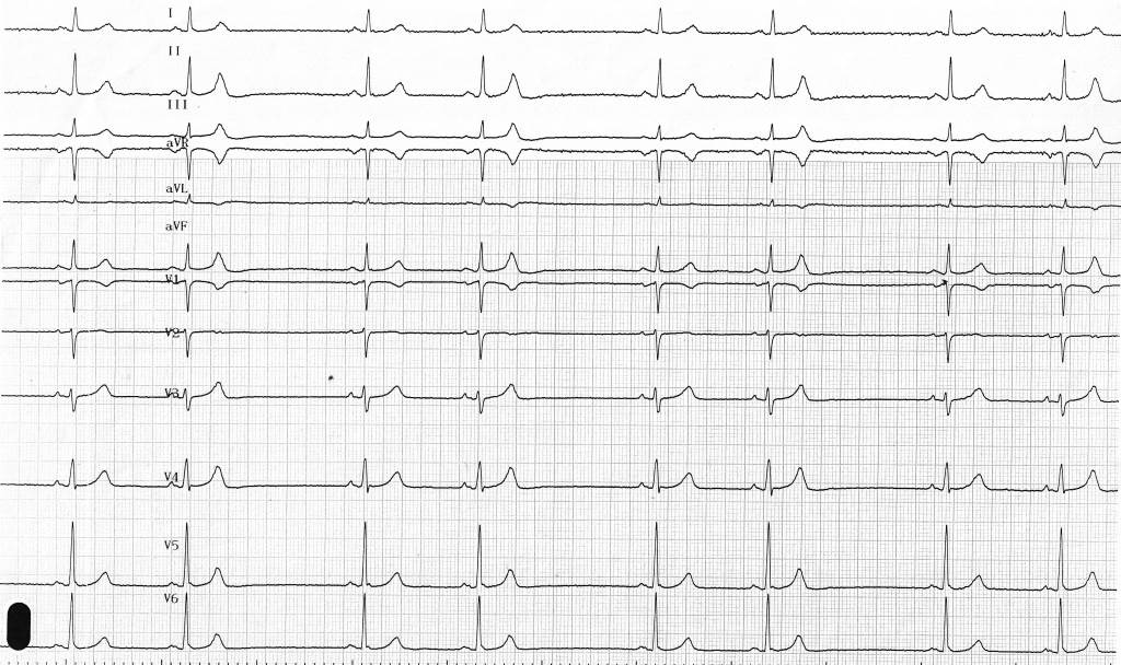 trace-5-3-ecg