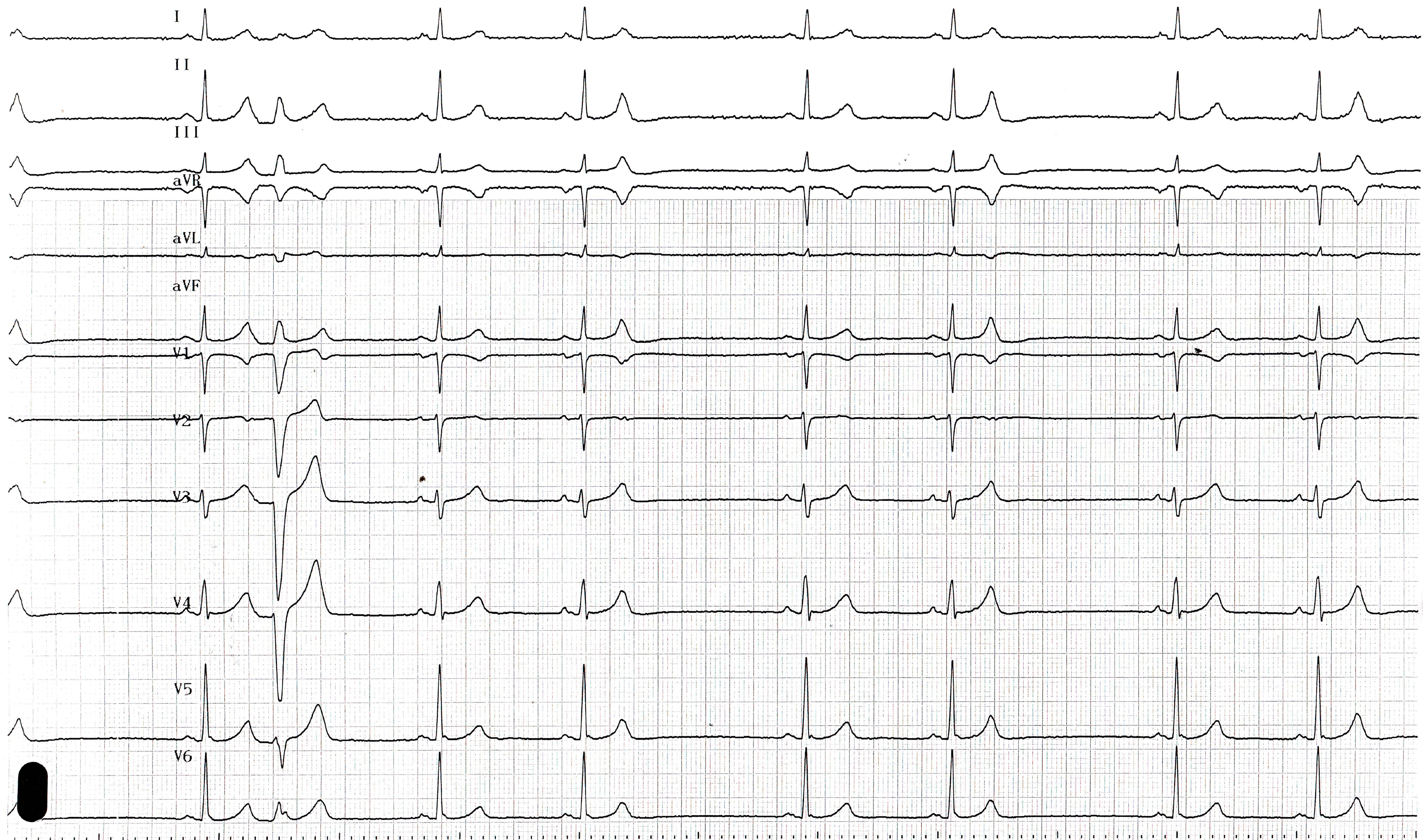 trace-5-4-ecg