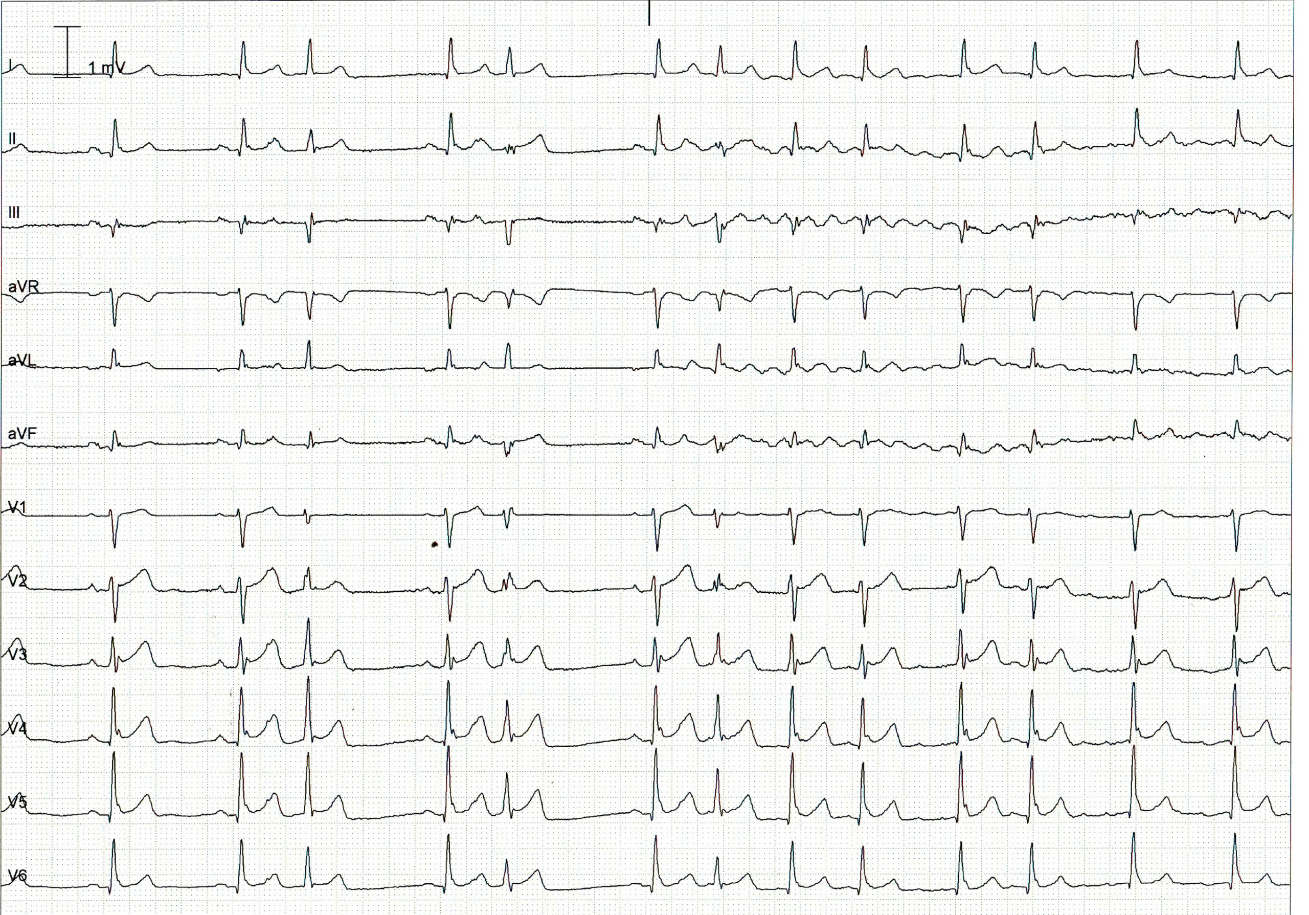 trace-5-5-ecg
