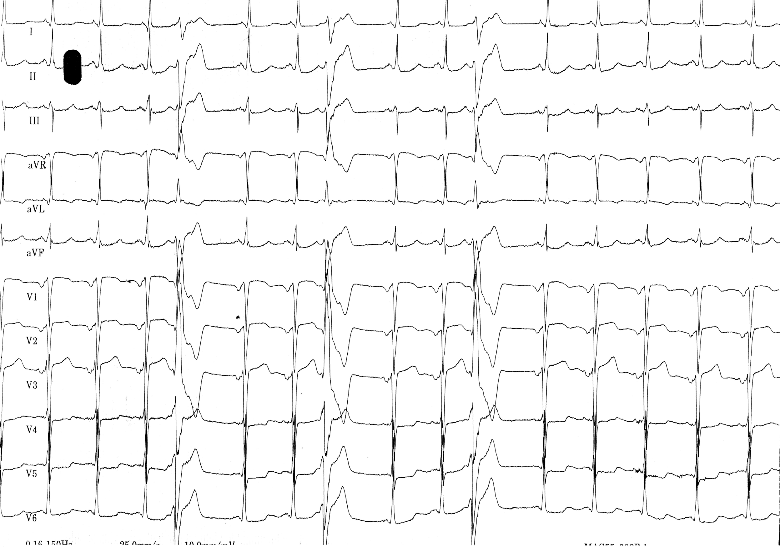 trace-5-6-ecg