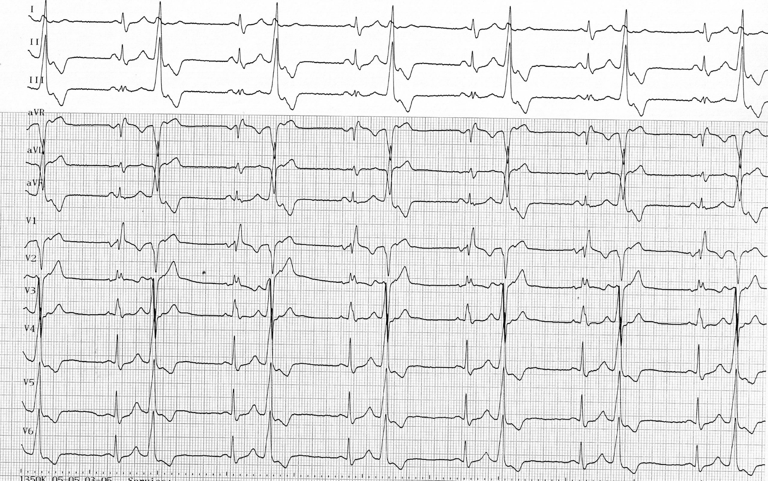 trace-5-7-ecg