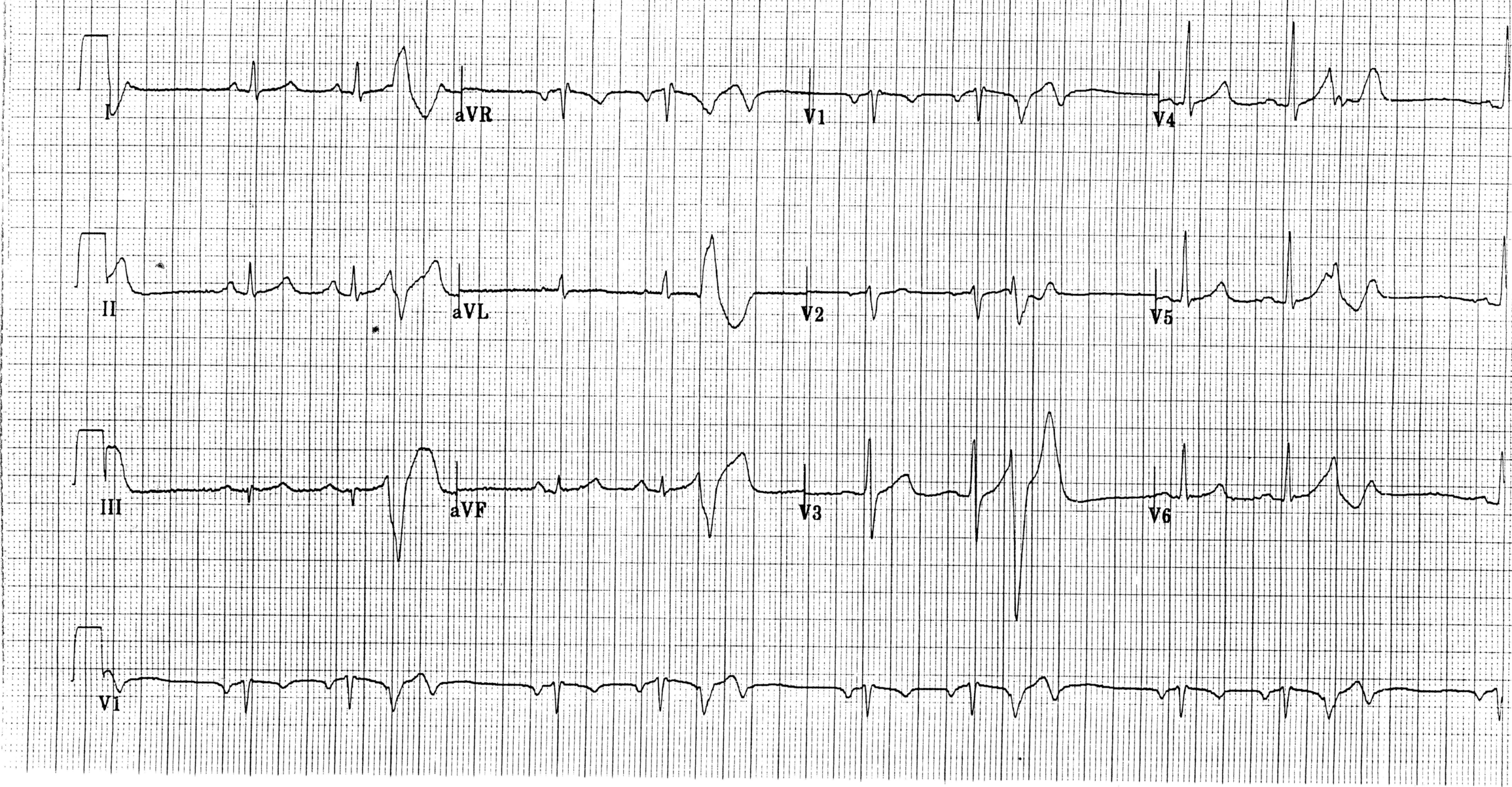 trace-5-8-ecg