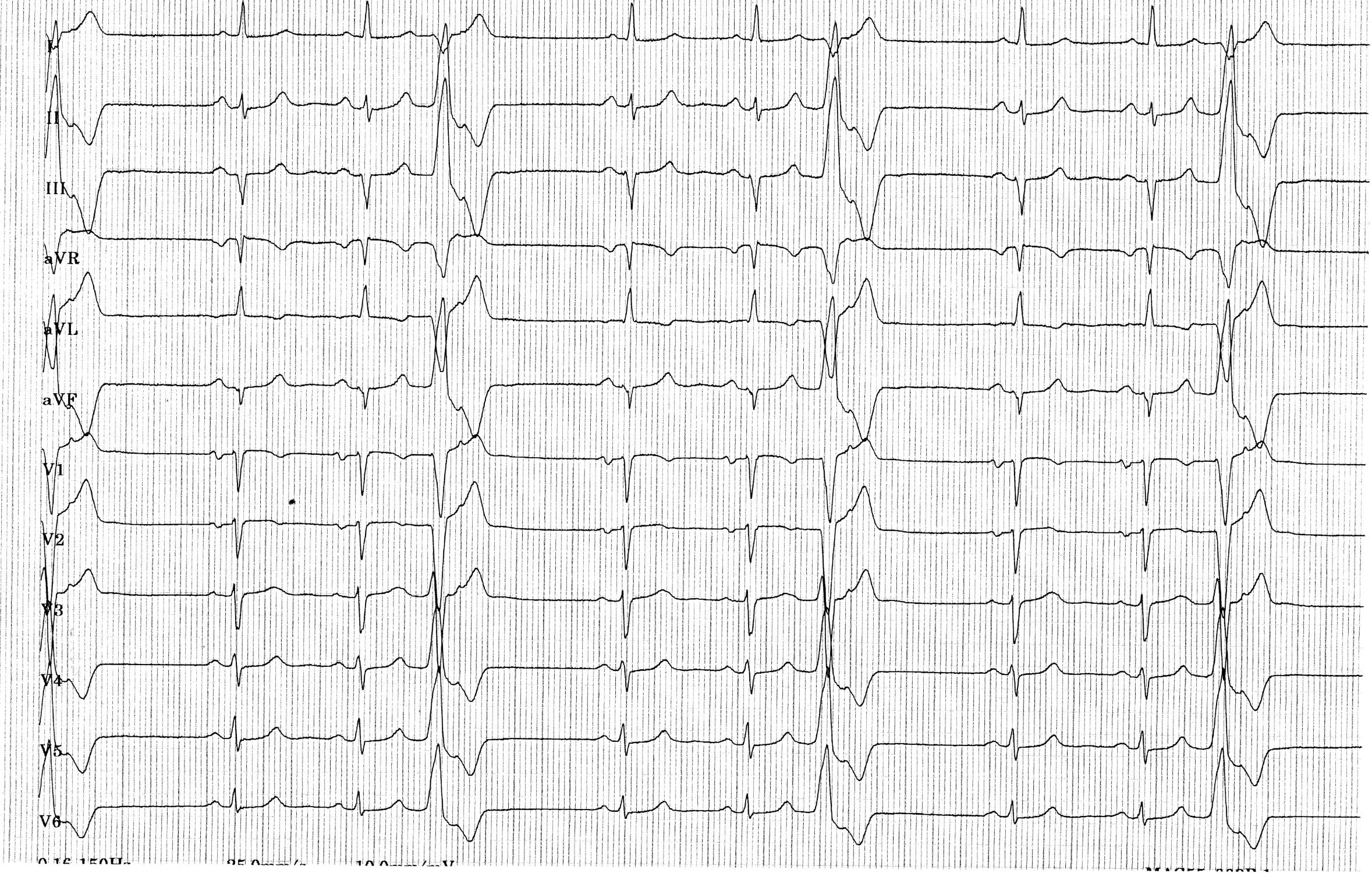 trace-5-9-ecg