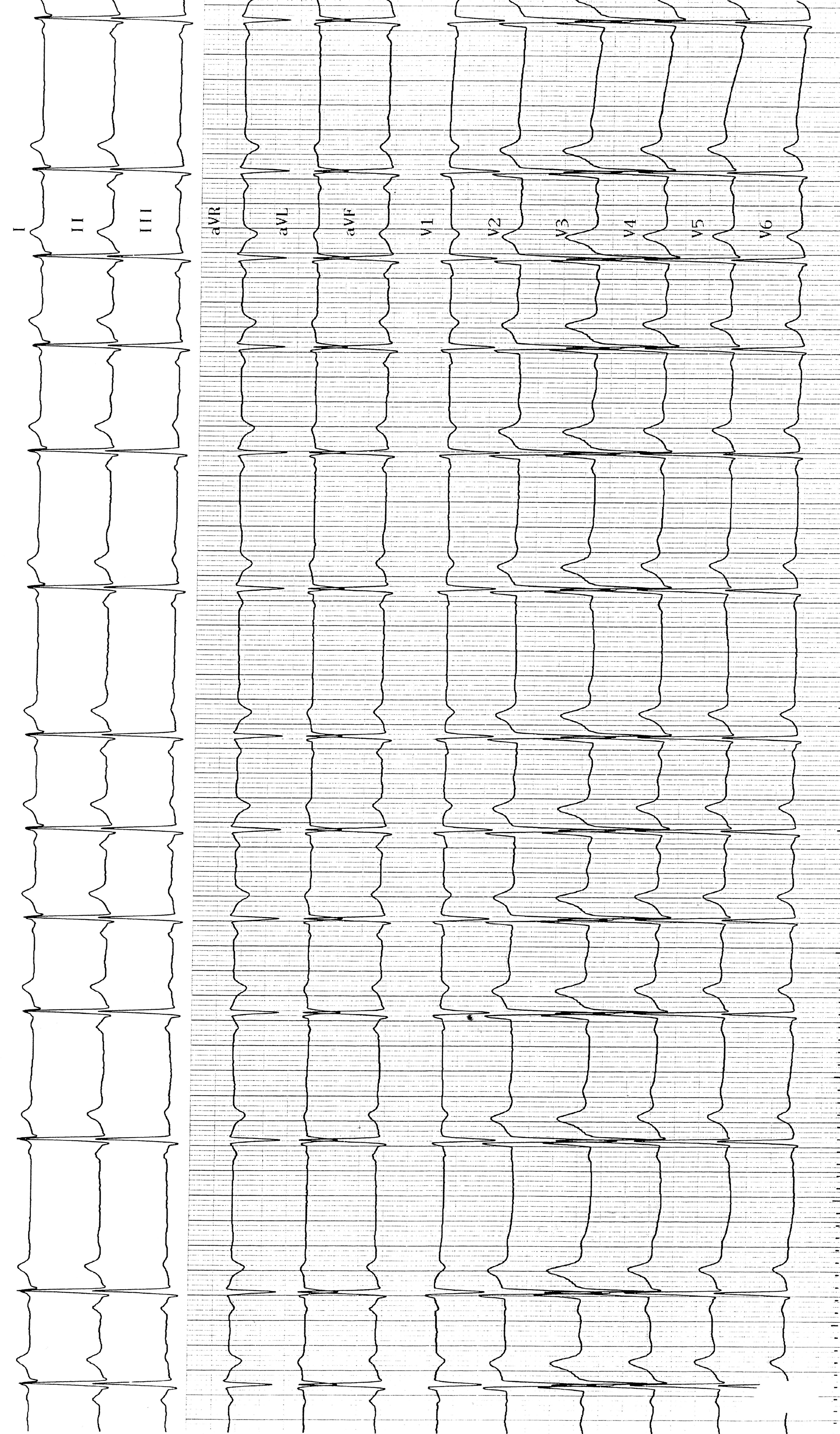 trace-6-1-ecg