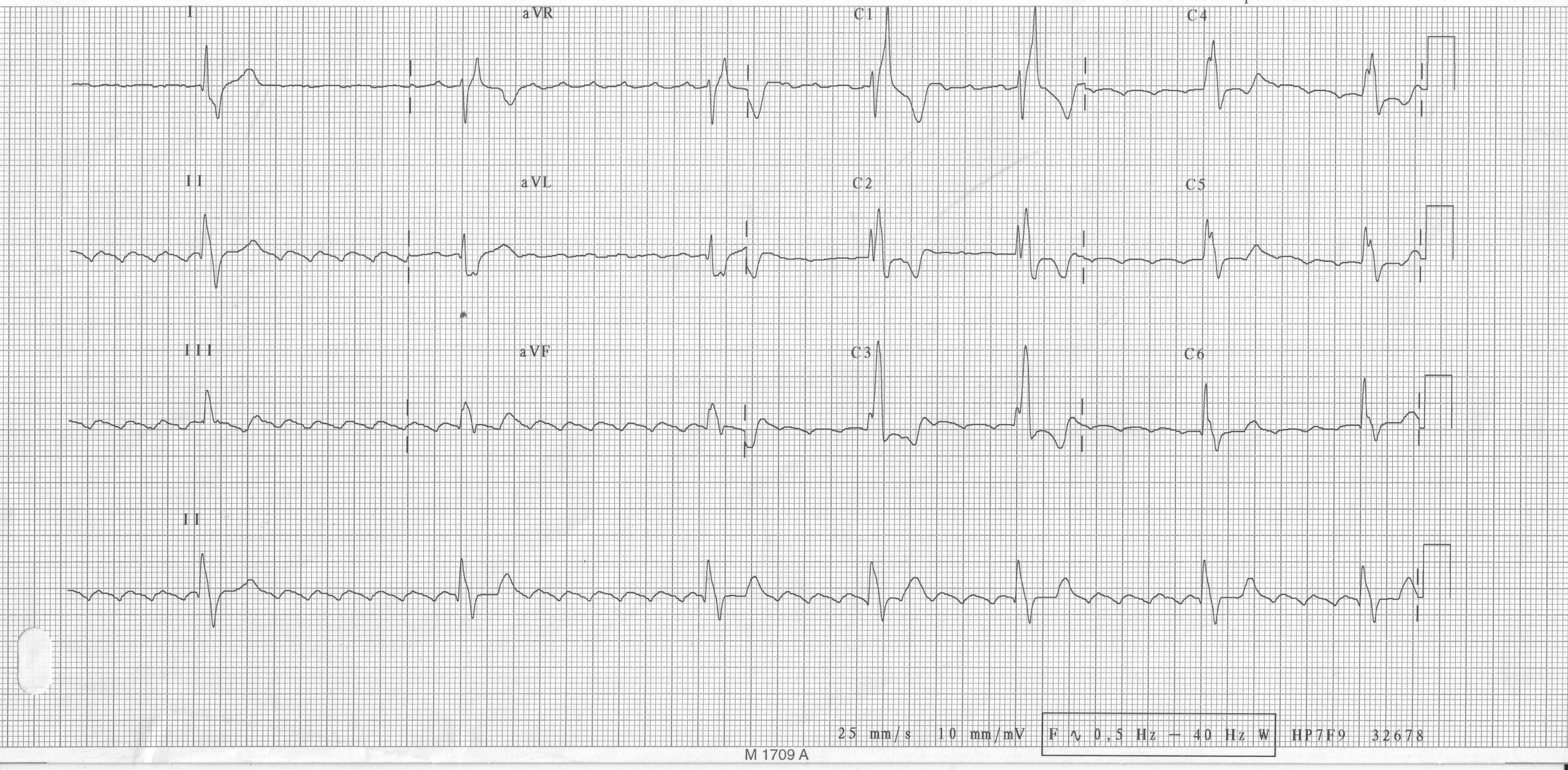 trace-6-10-ecg