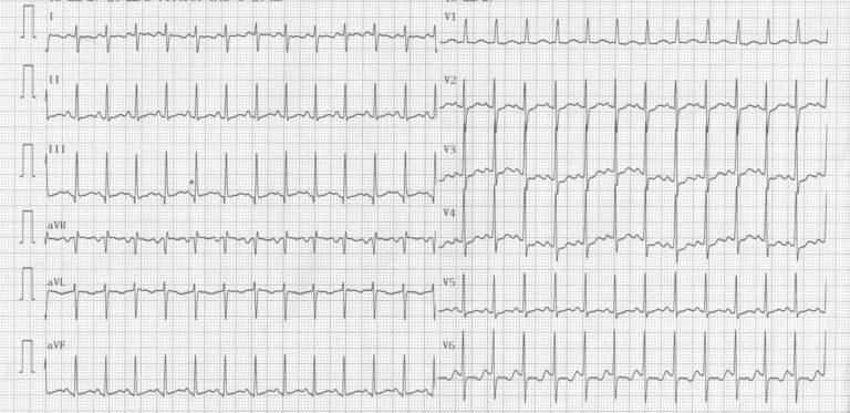 trace-6-11-ecg