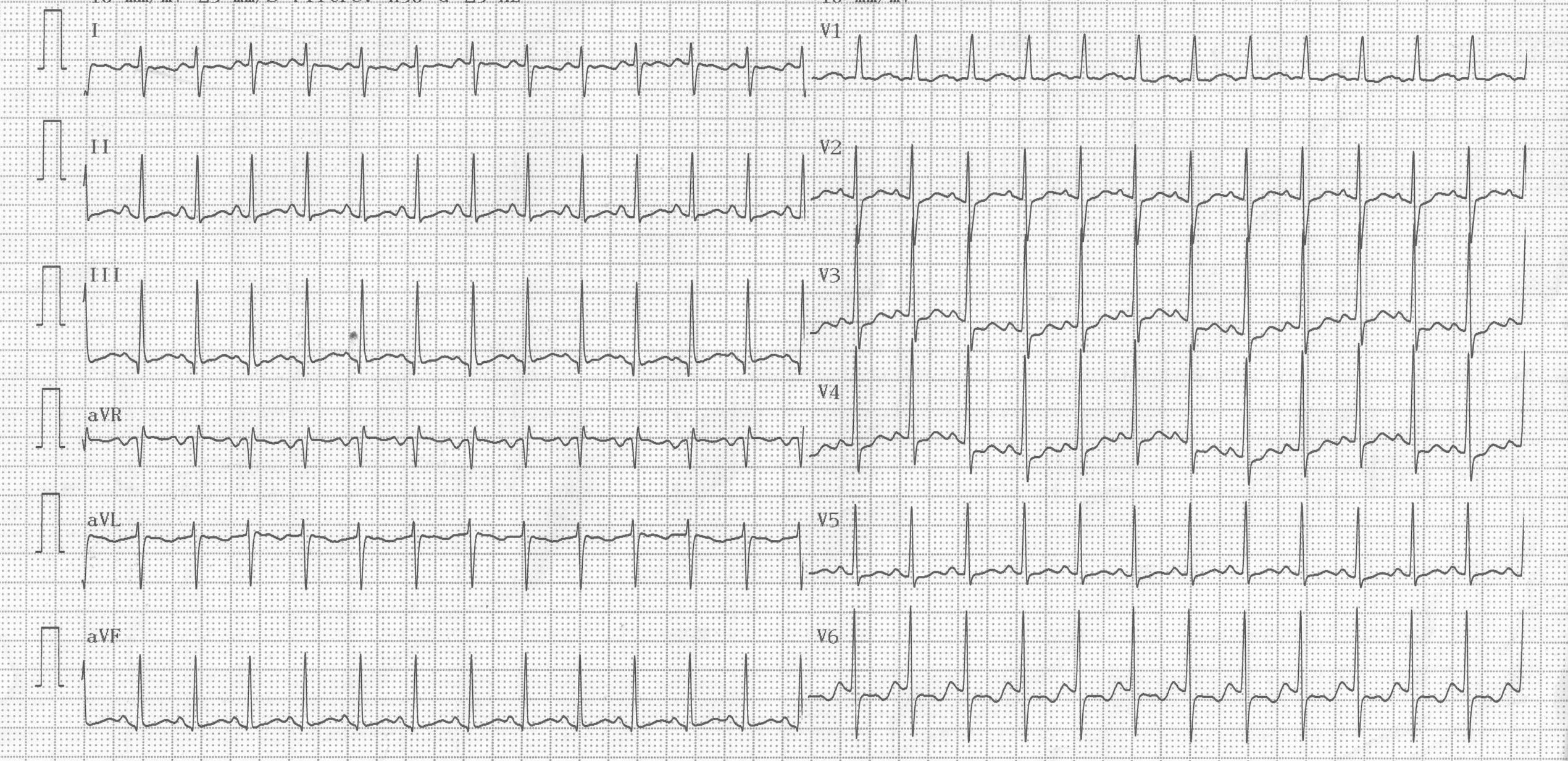 trace-6-11-ecg