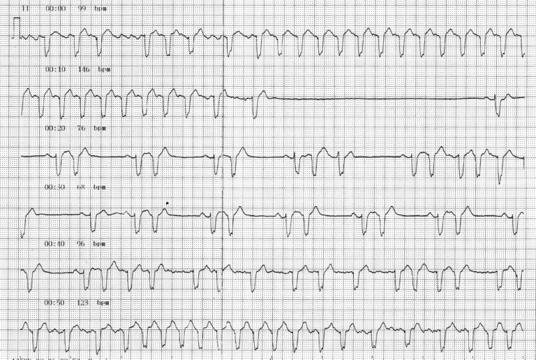 trace-6-12-ecg