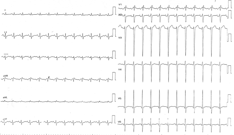 trace-6-2-ecg