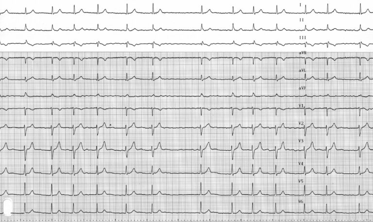 trace-6-3-ecg
