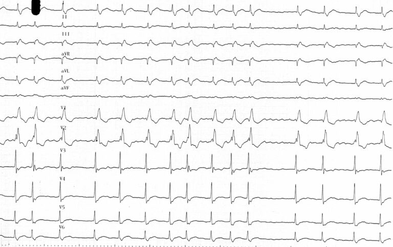 trace-6-4-ecg