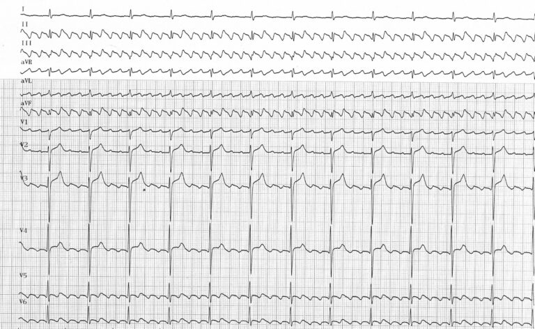 trace-6-5-ecg