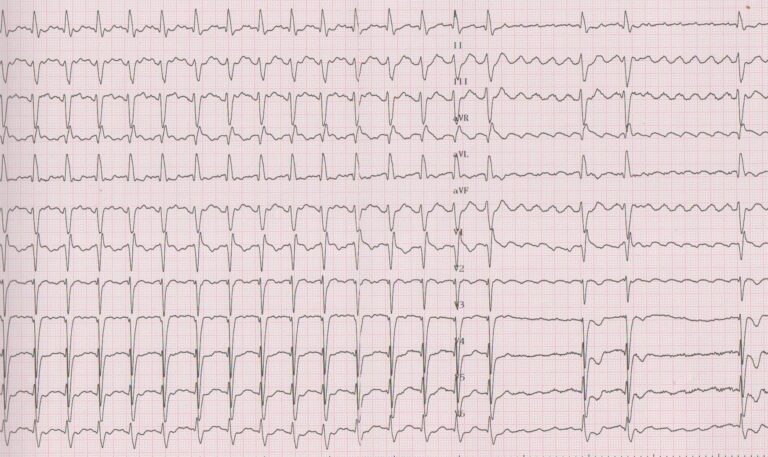 trace-6-6-ecg