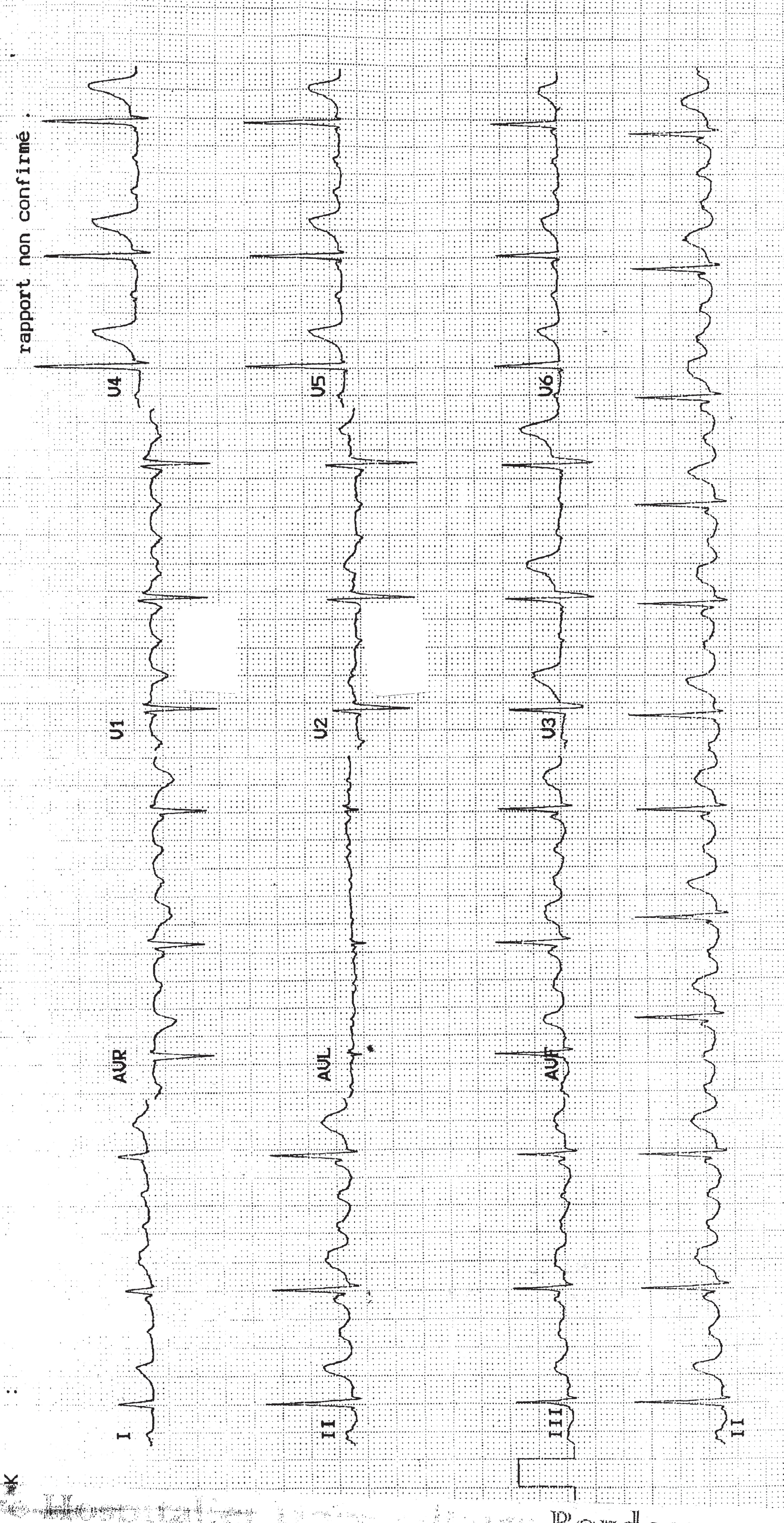 trace-6-7-ecg