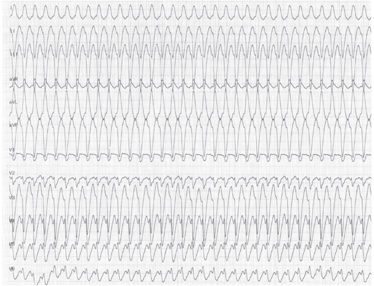 trace-6-8-ecg