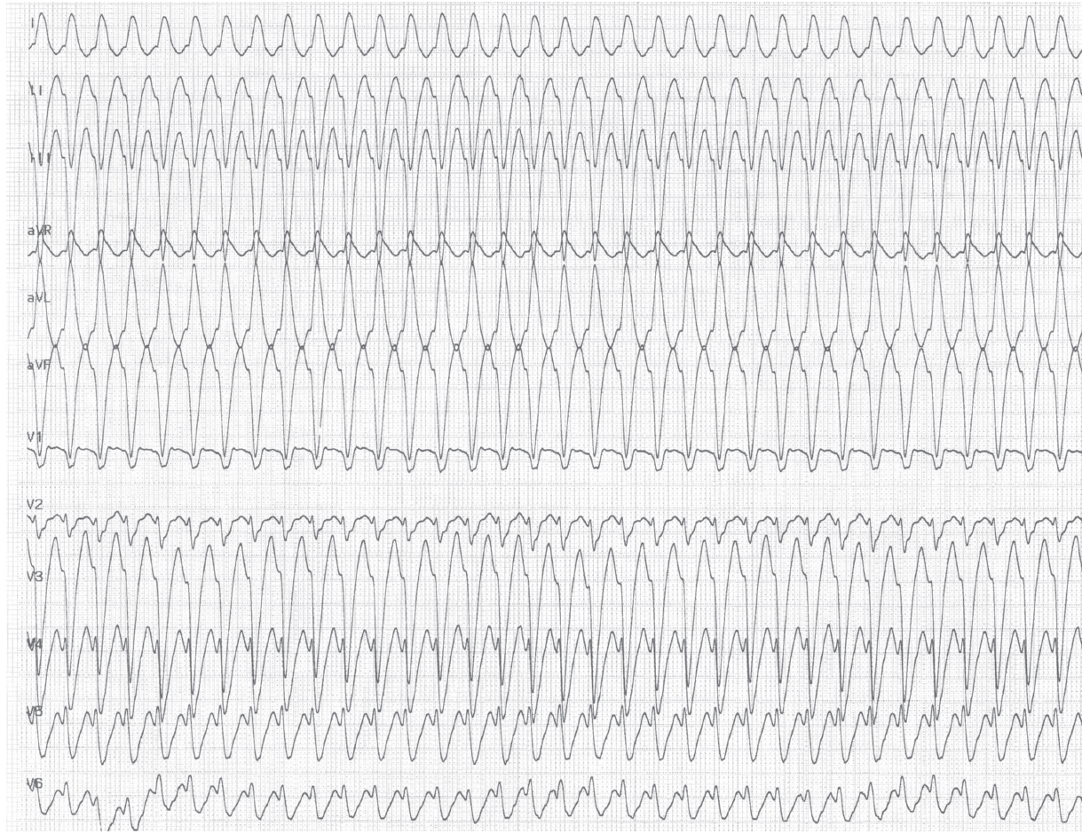 trace-6-8-ecg