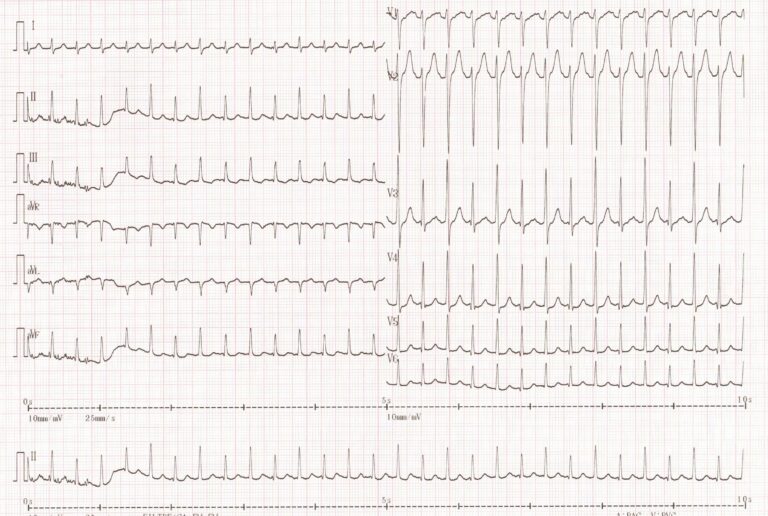trace-6-9-ecg