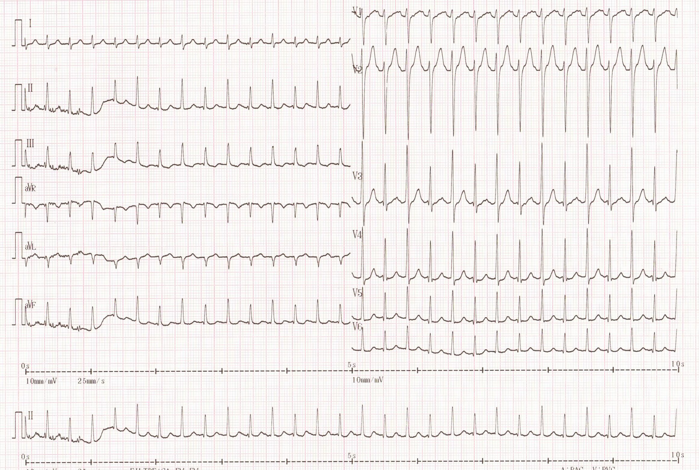 trace-6-9-ecg