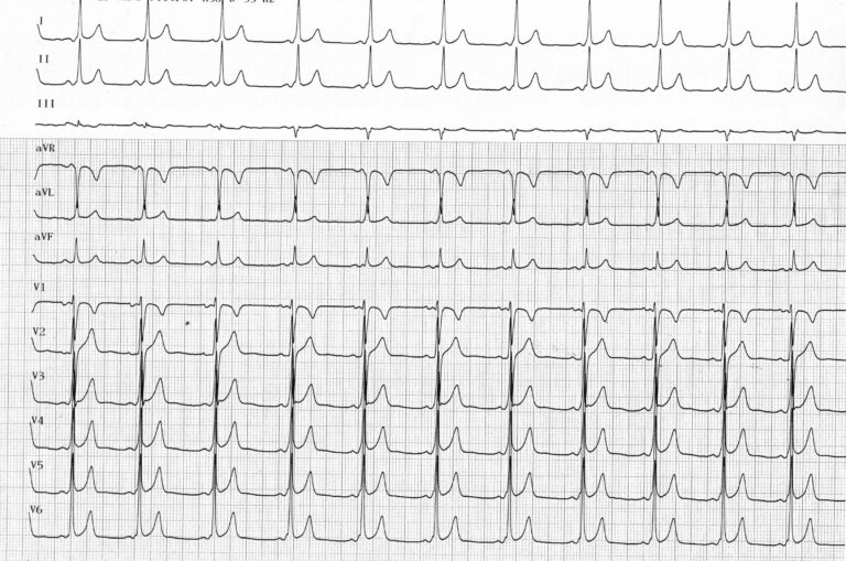 trace-7-1-ecg