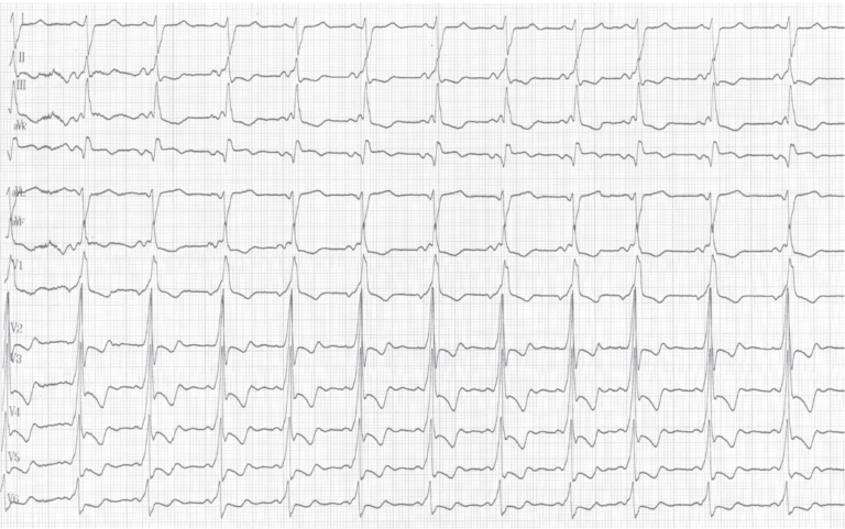 trace-7-10-ecg