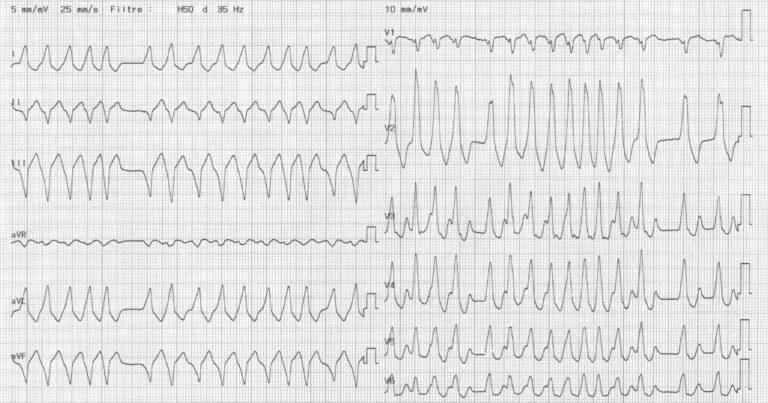 trace-7-11-ecg