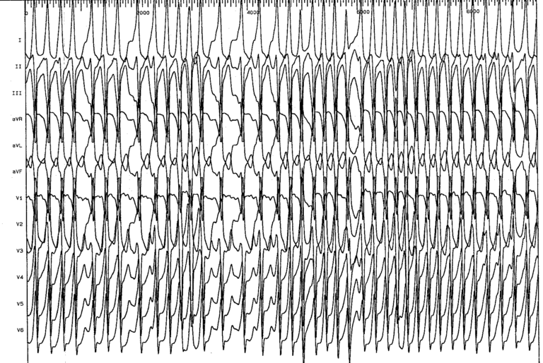 trace-7-12-ecg