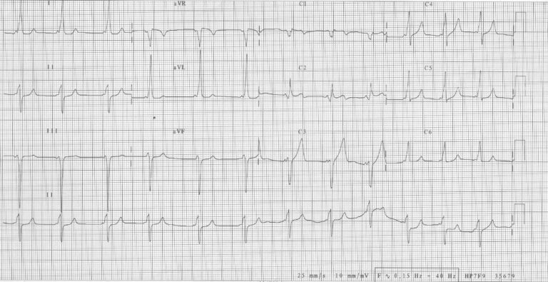 trace-7-13-ecg