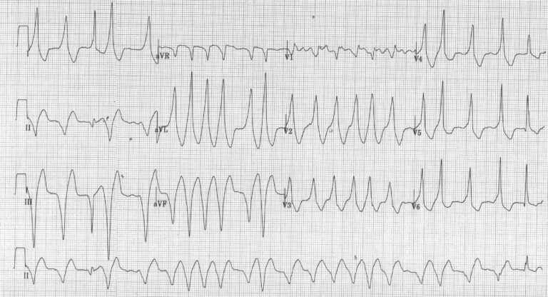 trace-7-14-ecg