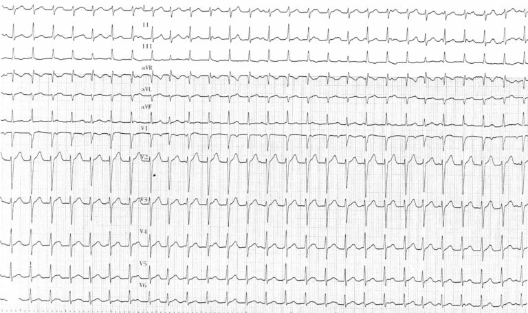 trace-7-15-ecg