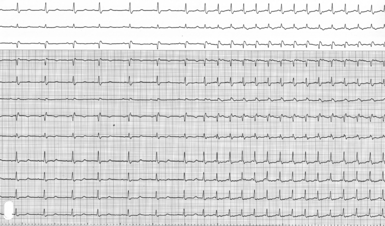 trace-7-16-ecg