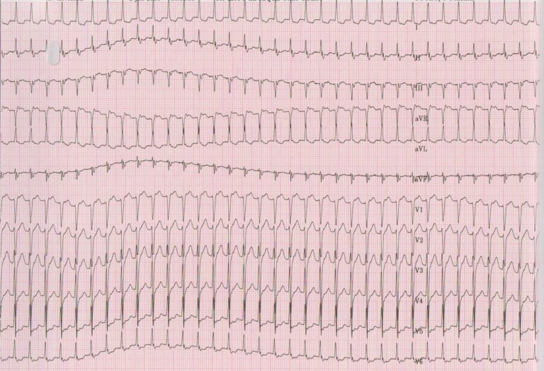trace-7-17-ecg
