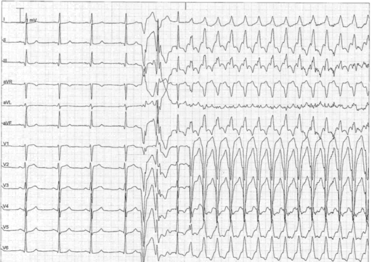 trace-7-18-ecg