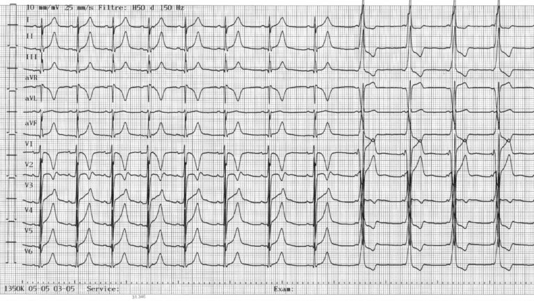 trace-7-2-ecg