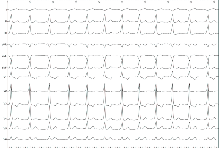 trace-7-3-ecg