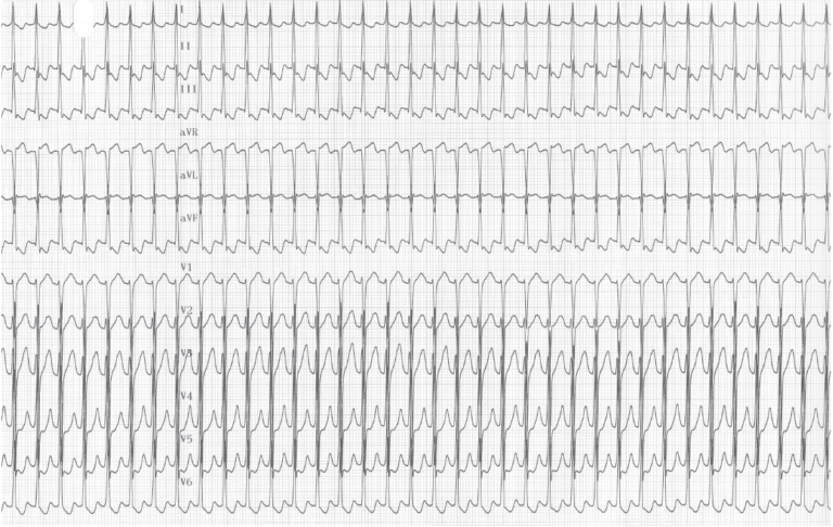 trace-7-4-ecg