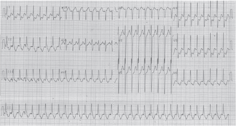 trace-7-6-ecg