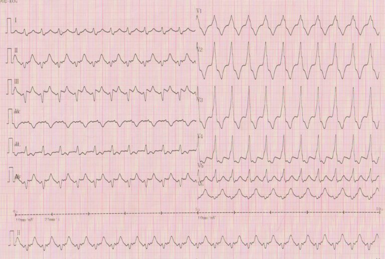 trace-7-7-ecg