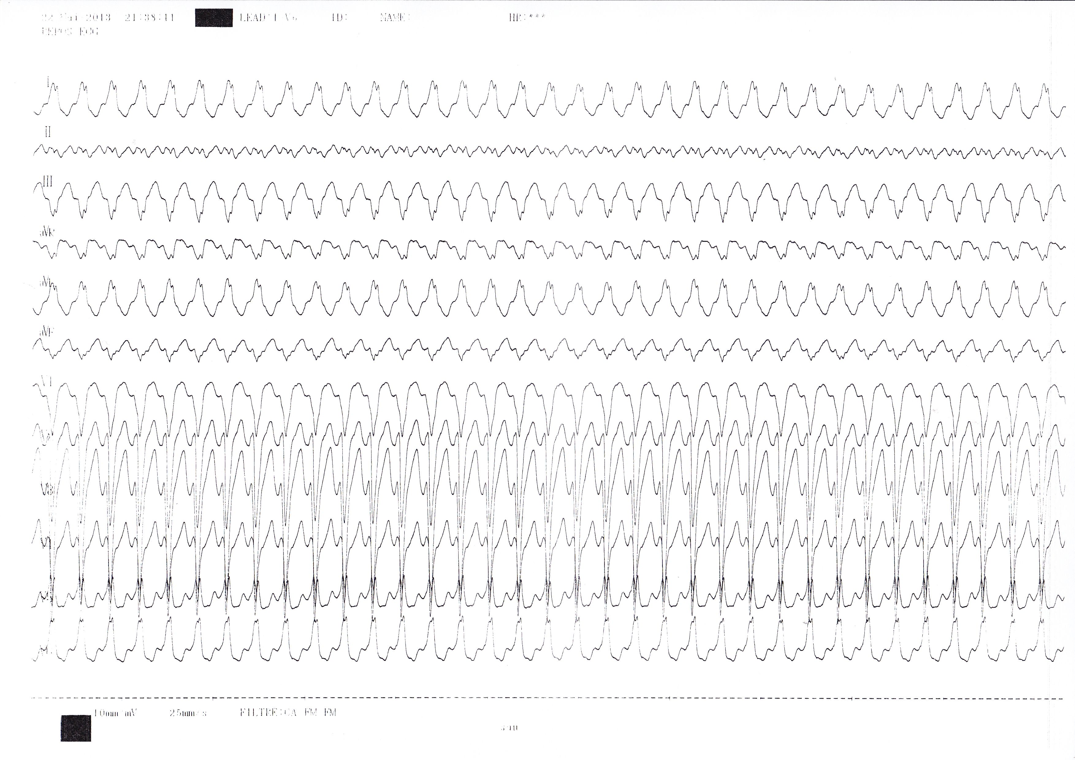 trace-7-8-ecg
