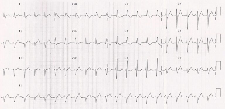trace-8-1-ecg