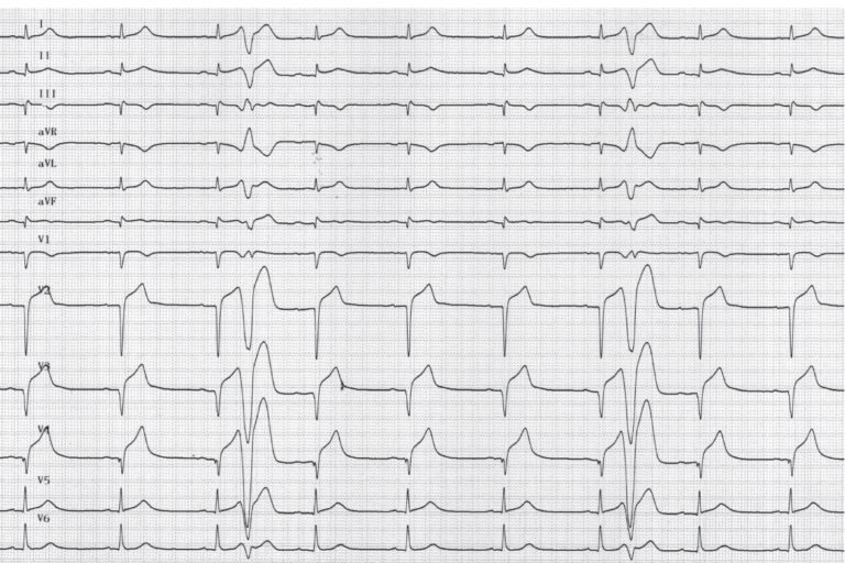 trace-8-10-ecg