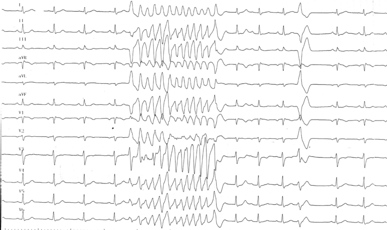 trace-8-11-ecg