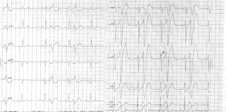 trace-8-12-ecg