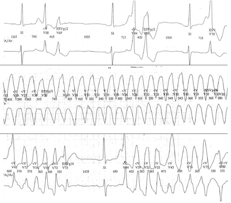 trace-8-13-ecg