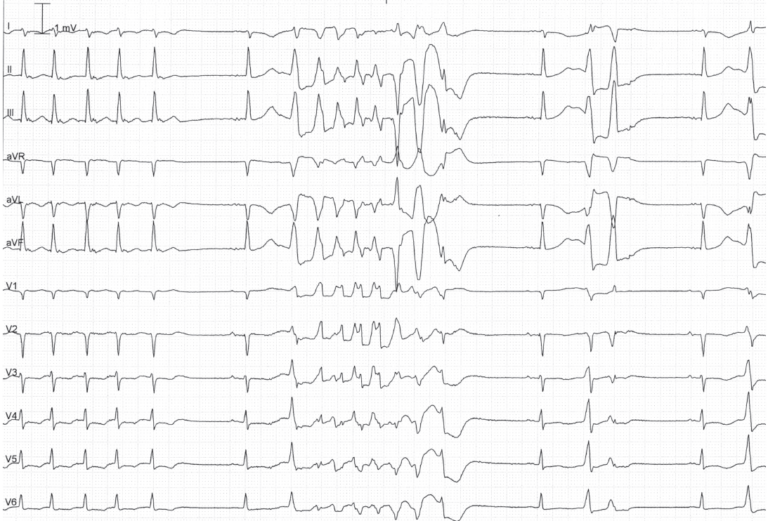 trace-8-14-ecg